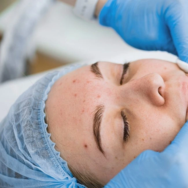 Acne Scar Treatment Process