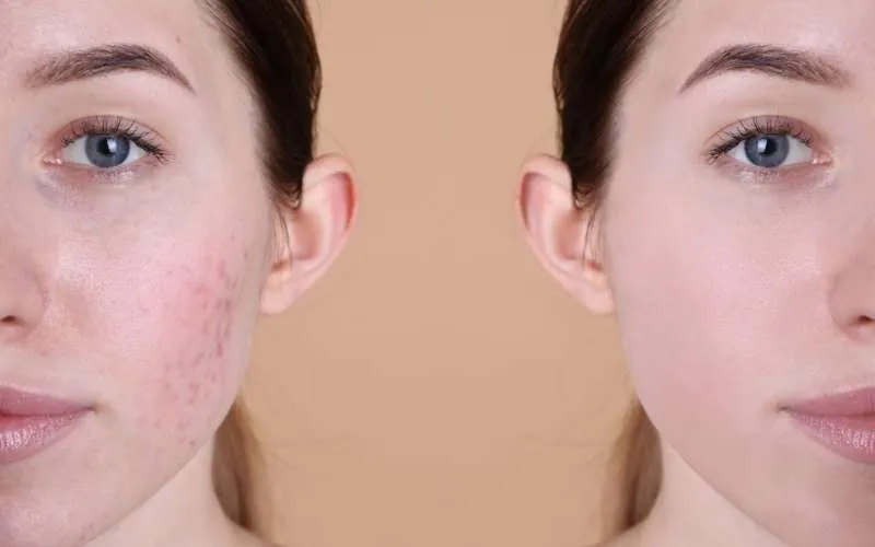 how to remove pimple scars naturally