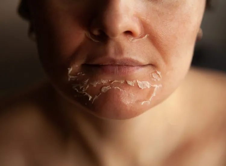 chemical peel facial benefits