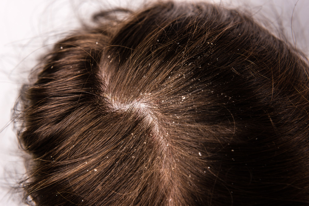 Does dandruff cause hair loss?