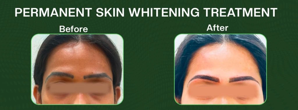 Permanent Skin Whitening at Sikara Clinics