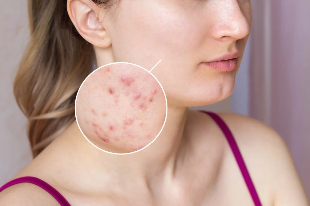 Reducing Acne and Breakouts