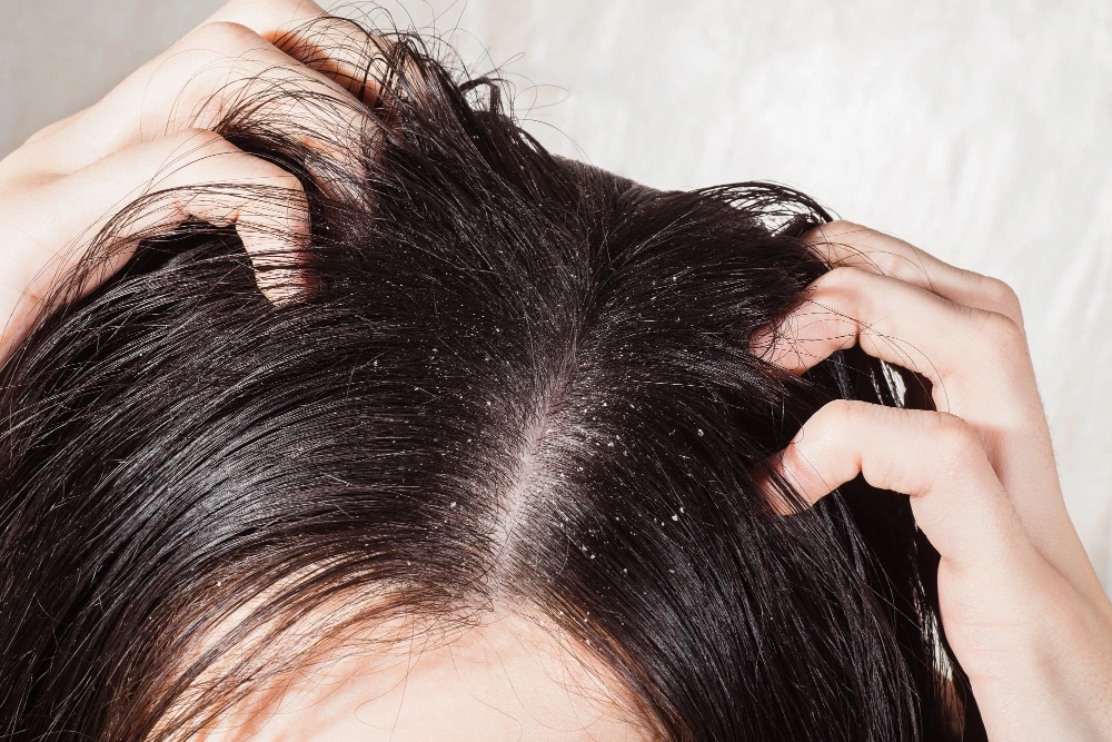 What Is Dandruff?