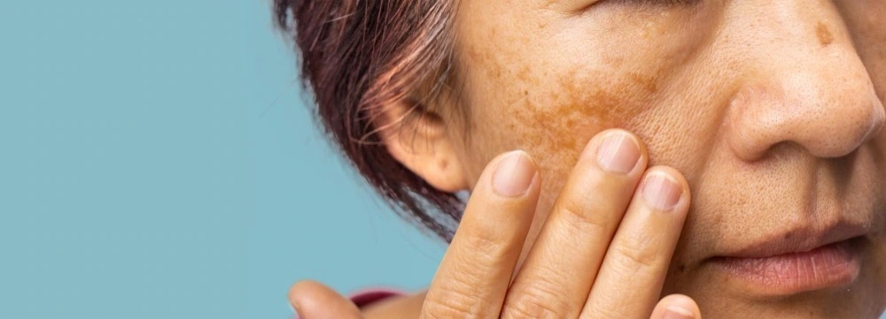 What is Melasma