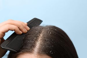 Does Dandruff Cause Hair Loss