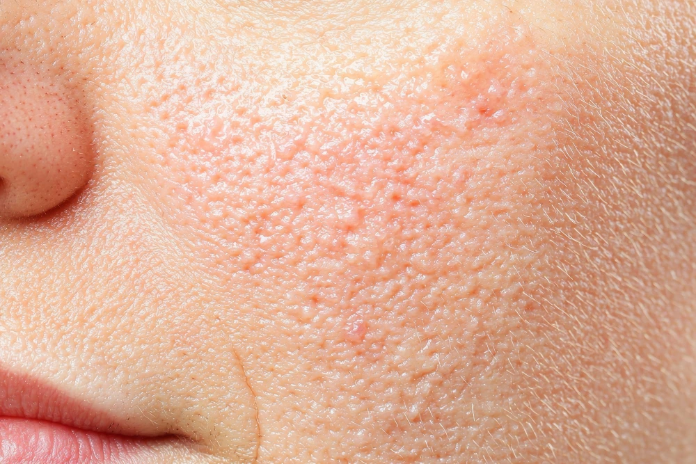 Causes of Open Pores