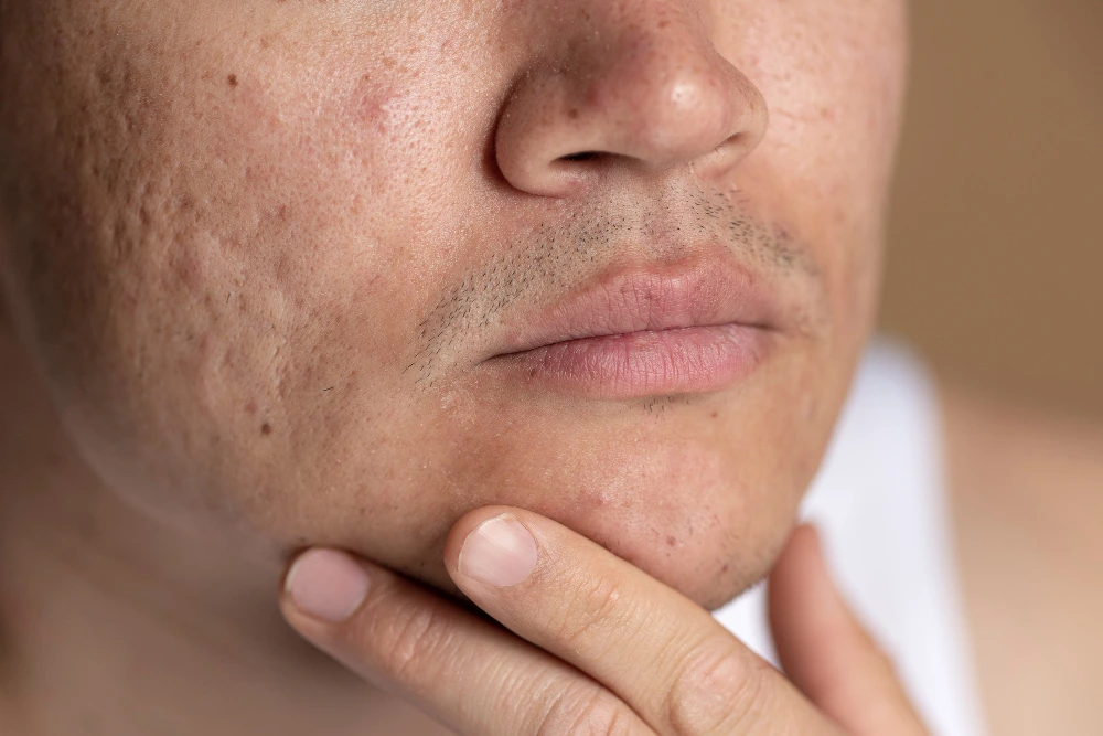 Open Pores Treatment
