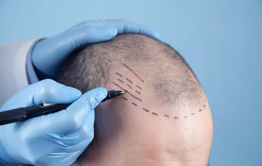 What is a Hair Transplant
