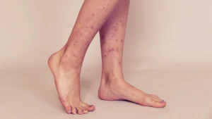 Dark Spots on Legs