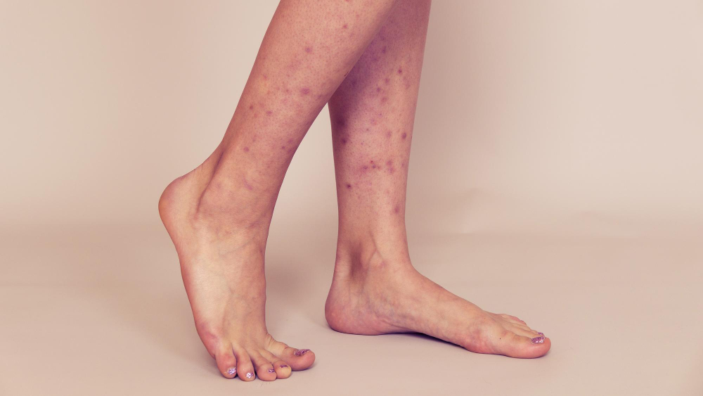 Dark Spots on Legs