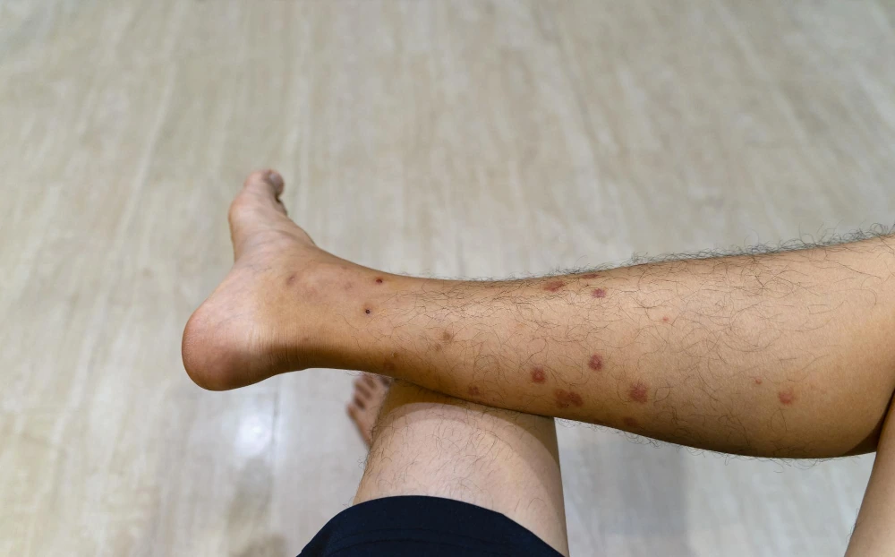 Treatment Options for Dark Spots on Legs