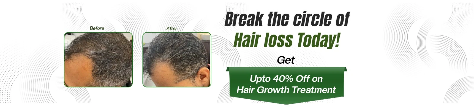 Hair Regrowth 40% off