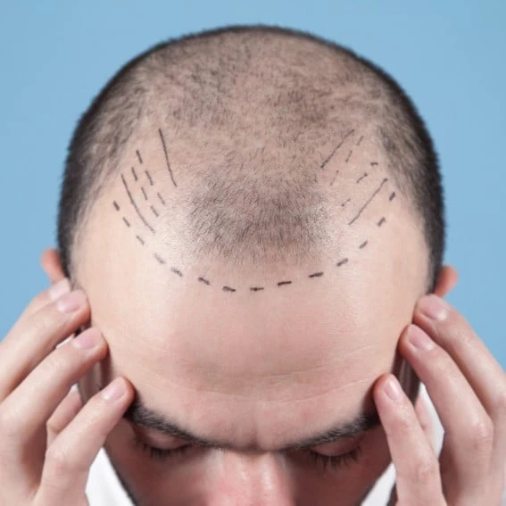 Hair Transplant
