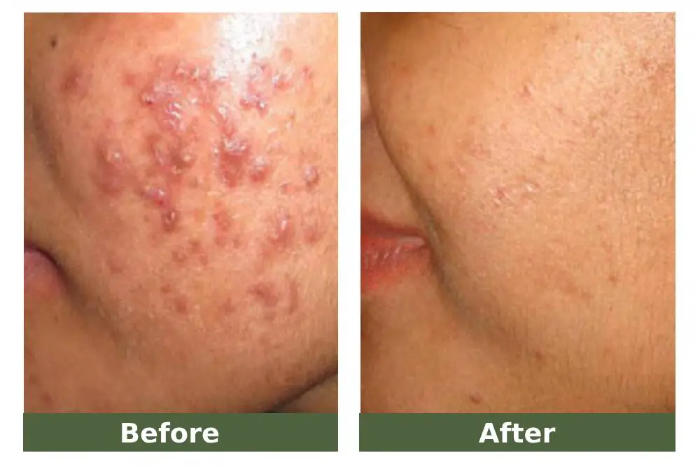 acne before and after