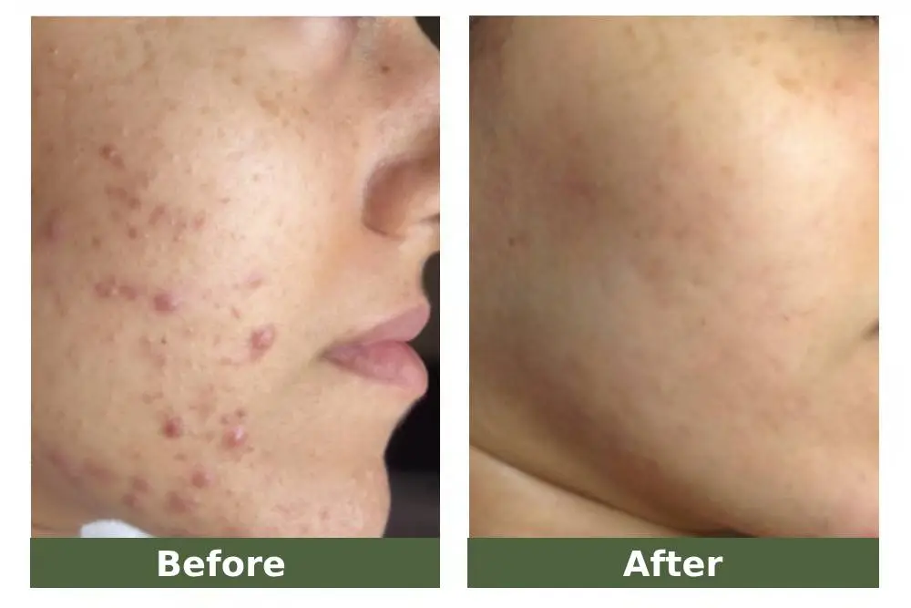 acne treatment before and after