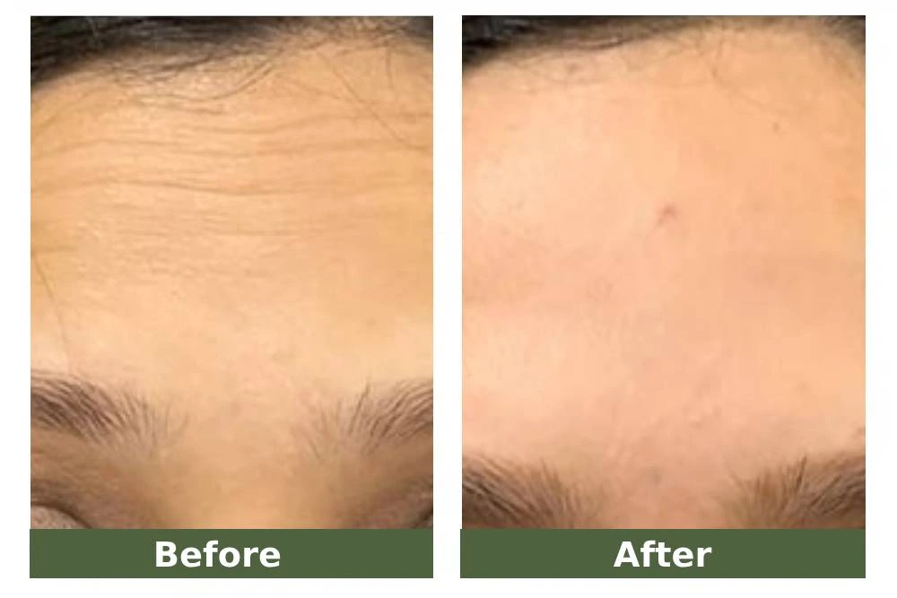 fine lines before and after