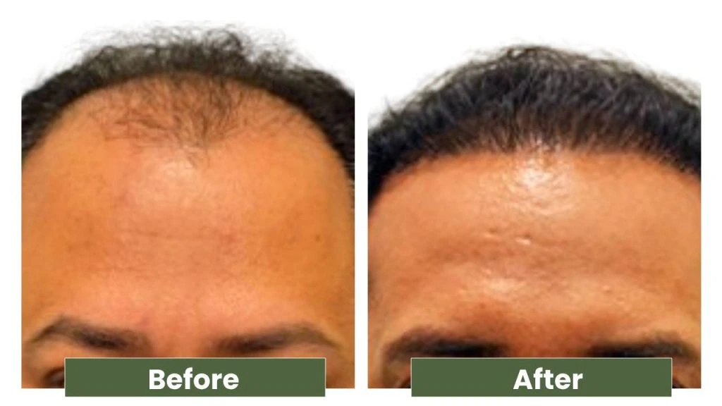 hair regrowth before after