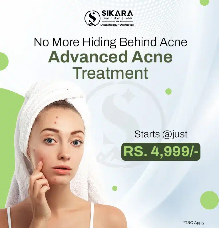 Advanced Acne Treatment - Sikara Clinics - Mobile