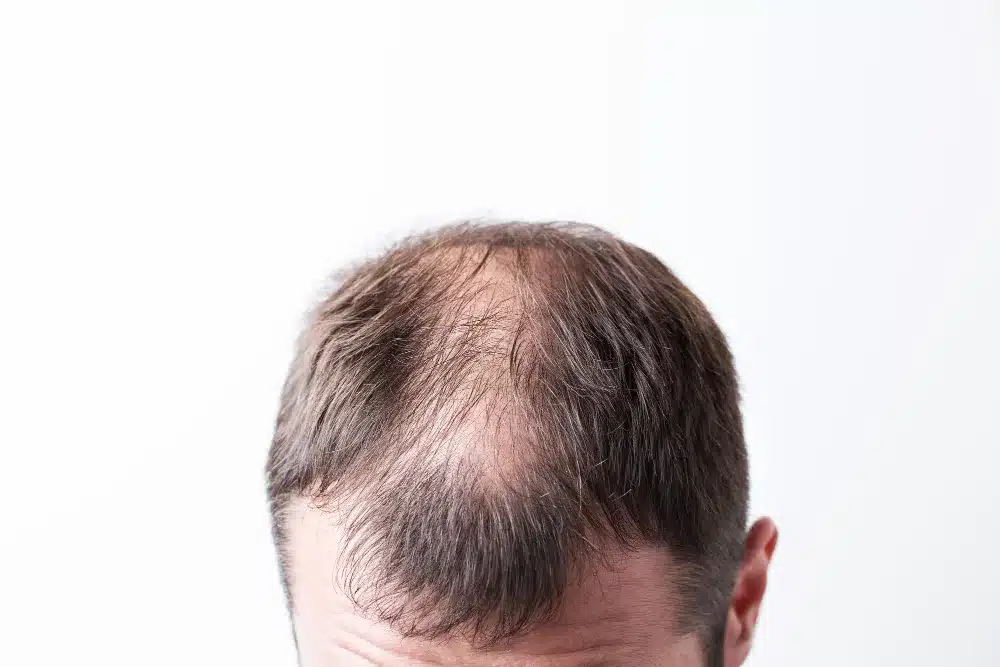 Cost of Hair Loss Treatment in Hyderabad