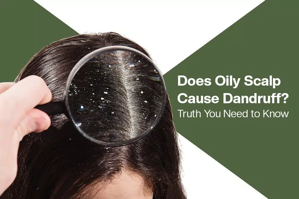 Does Oily Scalp Cause Dandruff