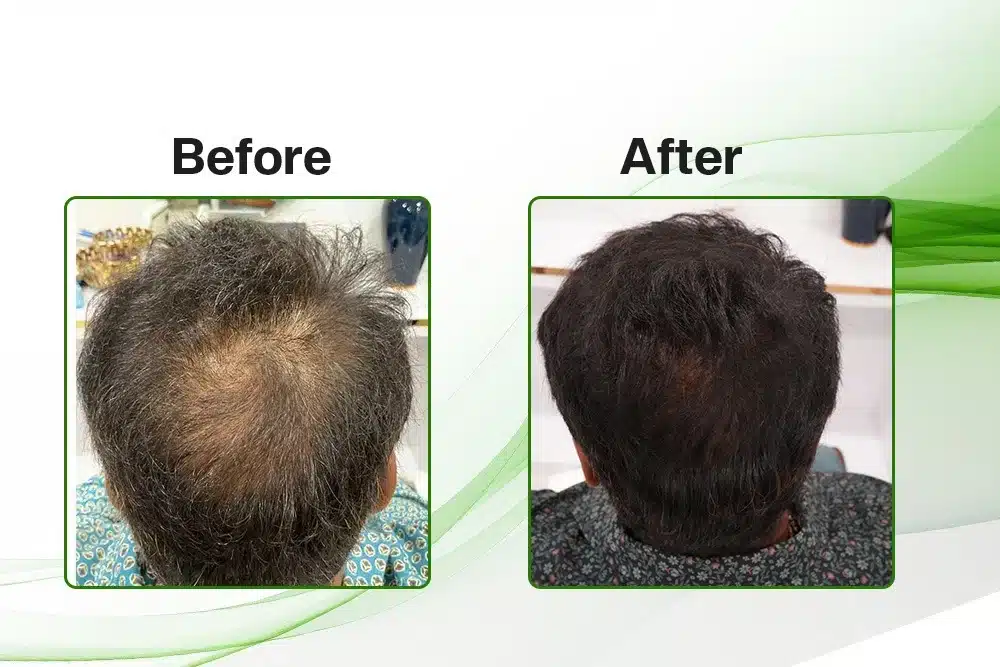 GFC Hair Treatment Before and After