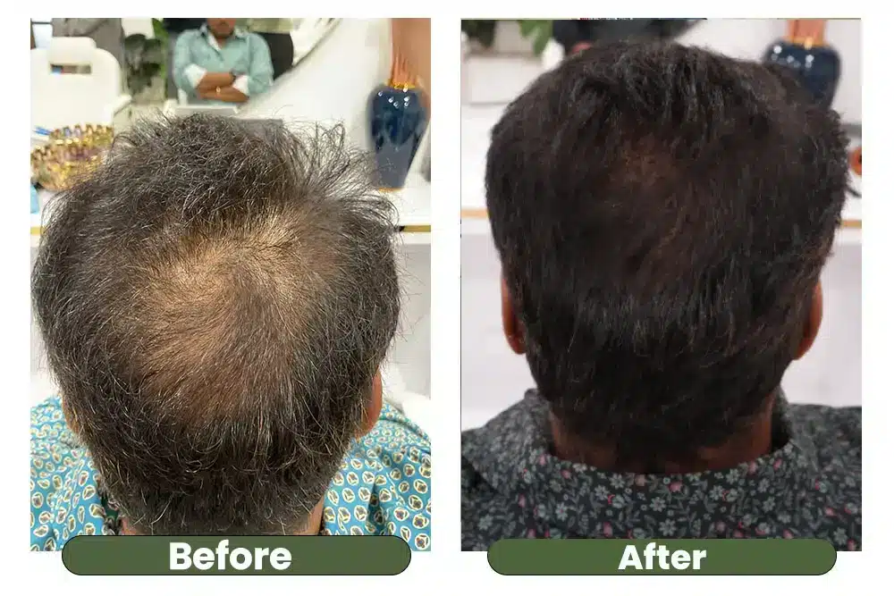 Hair regrowth before and after