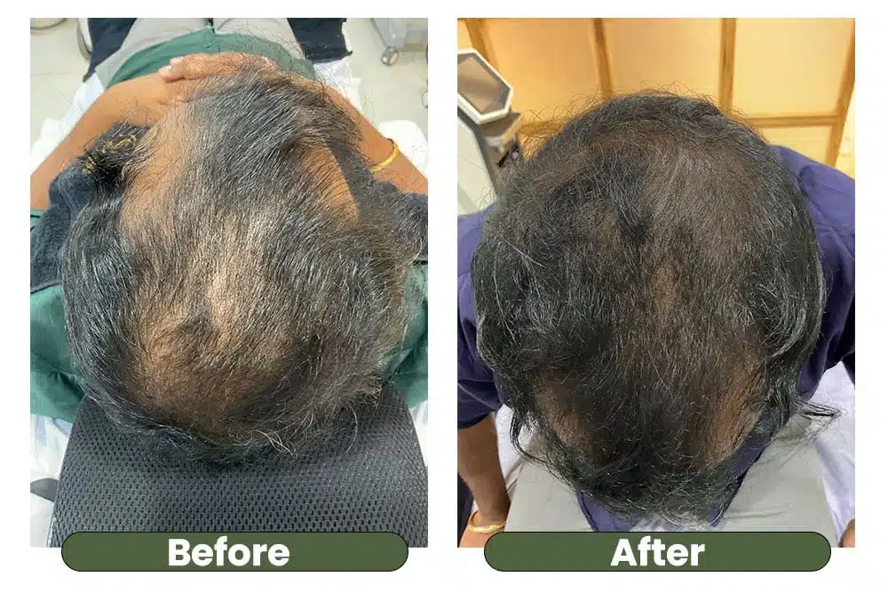 Hair regrowth treatment before and after picture