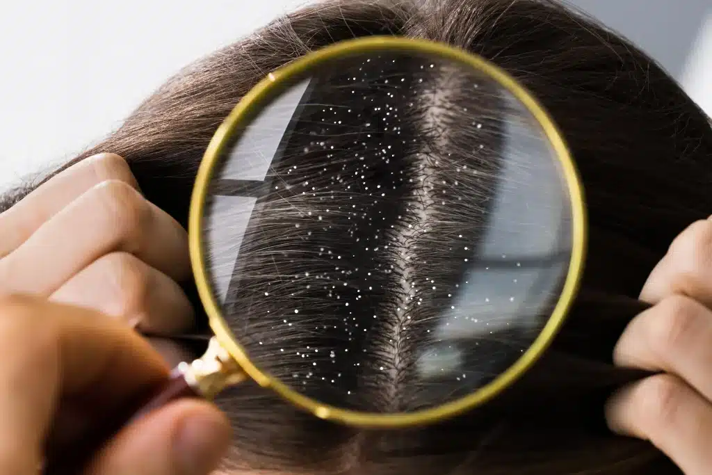 How to Manage Oily Scalp and Dandruff