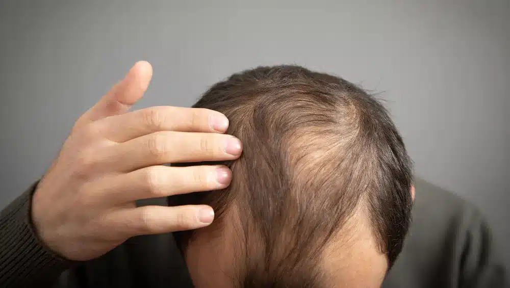 Solutions for Hair Loss Treatment in Hyderabad