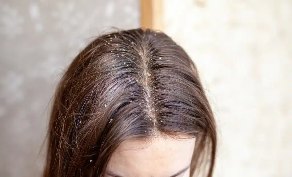 Why Does Your Scalp Become Oily