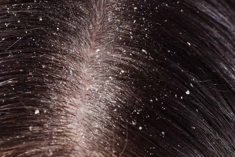 what is dandruff